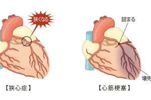 主な心臓の病気の仕組みと流れ。【左：狭心症】動脈硬化が進行したり、血管がけいれんすることで血液の通り道が狭くなり、胸痛が起こる。症状は一時的で自然に治まる。　【右：心筋梗塞】動脈硬化などが原因でできた血栓が冠動脈に詰まり、完全に塞がる。その先に血液が届かなくなり、心臓の筋肉が壊死する。