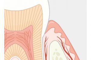 歯周病とは、歯の周りと歯茎に炎症を起こしている病のこと。正常な歯茎は、ハリがあり、健康的なピンク色だ。歯を磨いても出血はなく、口臭もない。正しいセルフケアとプロケアで維持できる。