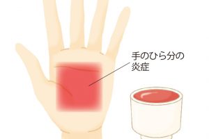 歯周ポケットが5㎜に達すると、炎症を起こしている面積が、72㎠（手のひらくらい）にも。結果、歯周病菌だらけの血をおちょこ1杯飲んでいることに。