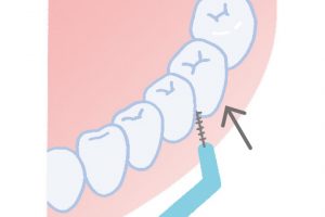 1. 歯茎に沿わせて歯間ブラシを軽く斜めに当てる。