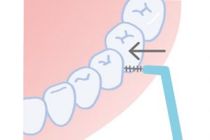 2. 歯間ブラシを水平にして、歯間部にゆっくり挿入する。