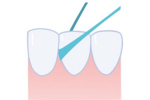 3. 歯と歯肉の境目に少し隠れるくらいまで糸を入れ、歯の側面の汚れを取るように糸を前後に数回動かす。反対側の歯の側面も同様に行う。