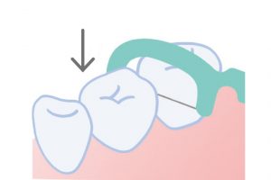 1. 歯と歯の間の入口にフロスピックをそっと差し入れる。