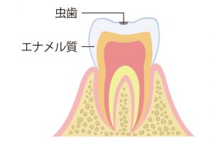 虫歯の進行と自覚症状。《C1》痛みなどの自覚症状がなく、エナメル質のみに虫歯がある状態。神経を保存し、虫歯の部分を最小限に除去して充填する治療が可能。