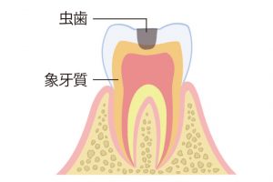 《C2》冷たいものを食べるとしみるなど、虫歯が象牙質まで広がっている。治療の際には麻酔後に神経を保存しながら虫歯部分を除去し、詰め物をする。