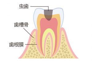 《C3》何も口にしない時も痛みを感じるなど虫歯が歯髄まで広がった状態。歯の神経を取り、かぶせものをするなどの治療が必要になる。