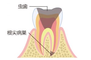 《C4》歯冠部の多くを失った虫歯の末期状態。通常は痛みもないが、歯肉の腫れや根尖部の膿から激痛が生じることも。抜歯するケースも多い。