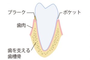 歯周病が進行していくプロセス。《1》歯と歯肉の境目の窪み（ポケット）にプラークがたまる。