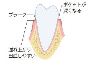 《2》プラークの中のばい菌により、歯肉が炎症を起こす。同時にポケットが深くなる。