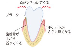 《3》歯周病と呼べる歯肉に守られた歯槽骨が減った状態に。歯がぐらつくようになる。