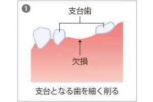 1. ブリッジをする場合、両隣の歯は健康であることが条件。場合によっては数本の歯を支台にすることもある。