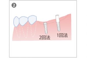 2. インプラントを埋め込む手術は、1回法は上部が歯肉の上に出ている。2回法はすべて歯肉の中に埋め込む。