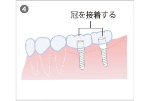 4. 人工歯を装着する。2回法の場合はアバットメントを任意の方向に立てることも可能になる。