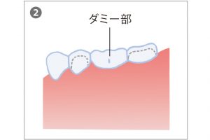 2. ブリッジをする場合、両隣の歯は健康であることが条件。場合によっては数本の歯を支台にすることもある。