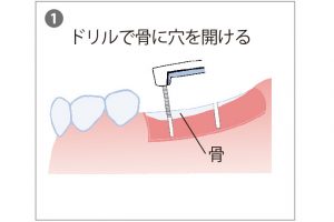 1. インプラントを埋め込む手術は、1回法は上部が歯肉の上に出ている。2回法はすべて歯肉の中に埋め込む。