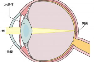 【健康な水晶体】水晶体は外から入った光を屈折させ、網膜に届ける。健康な水晶体は無色透明なので、光がきちんと屈折して鮮やかに見ることができる。