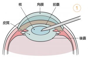 1.注射や点眼による局所麻酔の後、角膜の縁を切開して器具を挿入し、水晶体の前面を覆っている水晶体嚢の前面（前嚢）を切除する。