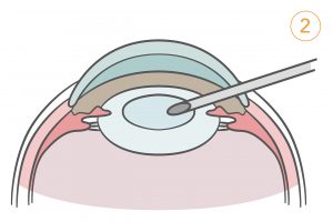 2.超音波で水晶体の核を細かく砕き、濁った皮質とともに吸引して取り出す。