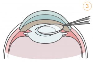 3.アクリル製の眼内レンズを挿入し、残した前嚢と後嚢の間に置く。
