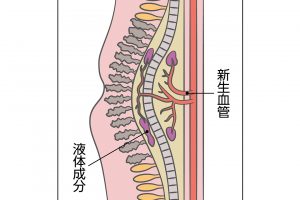 【加齢黄斑変性の黄斑部】黄斑部に老廃物がたまったり、異常な血管（新生血管）ができ液体成分が漏れたりすると、黄斑部が傷んでしまう。