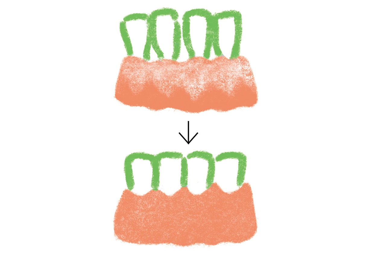 歯ぐきのアンチエイジング、歯肉移植で口腔内の健康を維持。