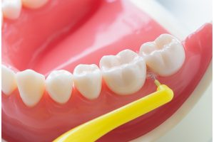 歯茎の丘のカーブに沿わせるように、わずかに斜め上向きに入れるのがポイント。歯茎を傷めないように細心の注意を払うこと。