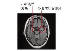 【脳変性】記憶の玄関口といわれる海馬とその周辺がやせている。変性の状態によって症状の原因を特定。この画像は、アルツハイマー型認知症。