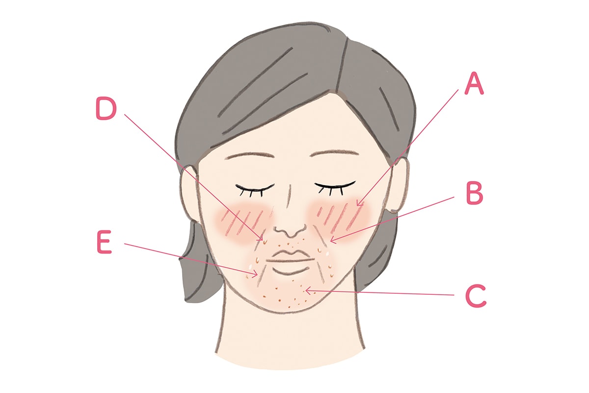 マスクで肌荒れ、乾燥、消毒荒れ。気になる症状を解消する方法。