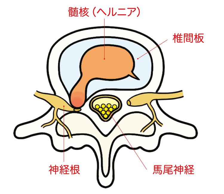 代表的な腰の病気、椎間板ヘルニアの症状や治療法。 | 健康 | クロワッサン オンライン