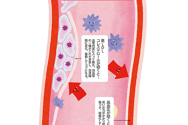 原因を知って数値をコントロール。コレステロール、血圧、血糖値はなぜ上がる？