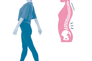 腰痛になりやすい反り腰タイプ。重心が前に寄って倒れそうになるのを、体幹を後ろに反らせてバランスを取っている歩き方