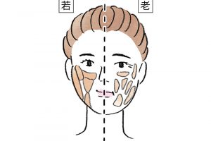 【脂肪】ほうれい線周りの頰や口周り、あご下などは加齢とともに脂肪が増え、垂れ下がり、顔が台形に。一方、おでこや頰骨周囲、こめかみ付近の脂肪は薄くなる。脂肪同士に隙間もでき、たるんでいく。